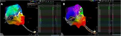 Case Report: Epi-endocardial bridges in refractory cavotricuspid isthmus-dependent atrial flutter: technical analysis of epi-endocardial breakthrough